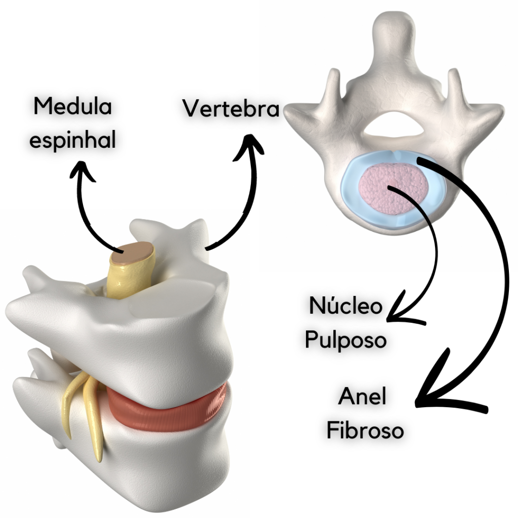 Hérnia de Disco Saiba o que é Medicina Ortopédica