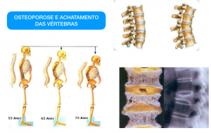 osteoporose coluna