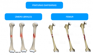 Fratura diafisária deve operar