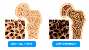 o que é osteoporose