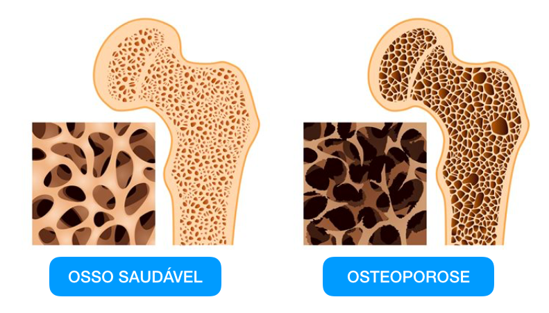 Osteoporose O que é Como Prevenir e Tratar Medicina Ortopédica