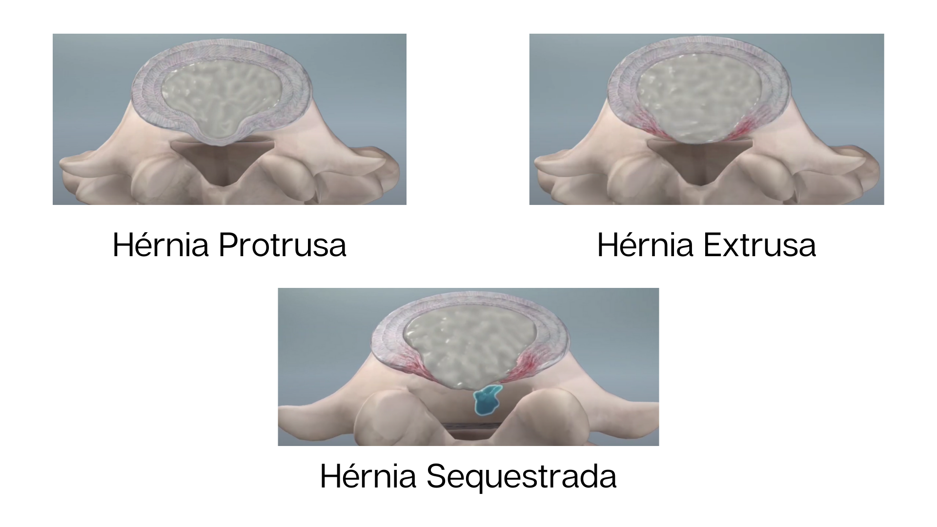 O QUE É HÉRNIA DE DISCO Medicina Ortopédica