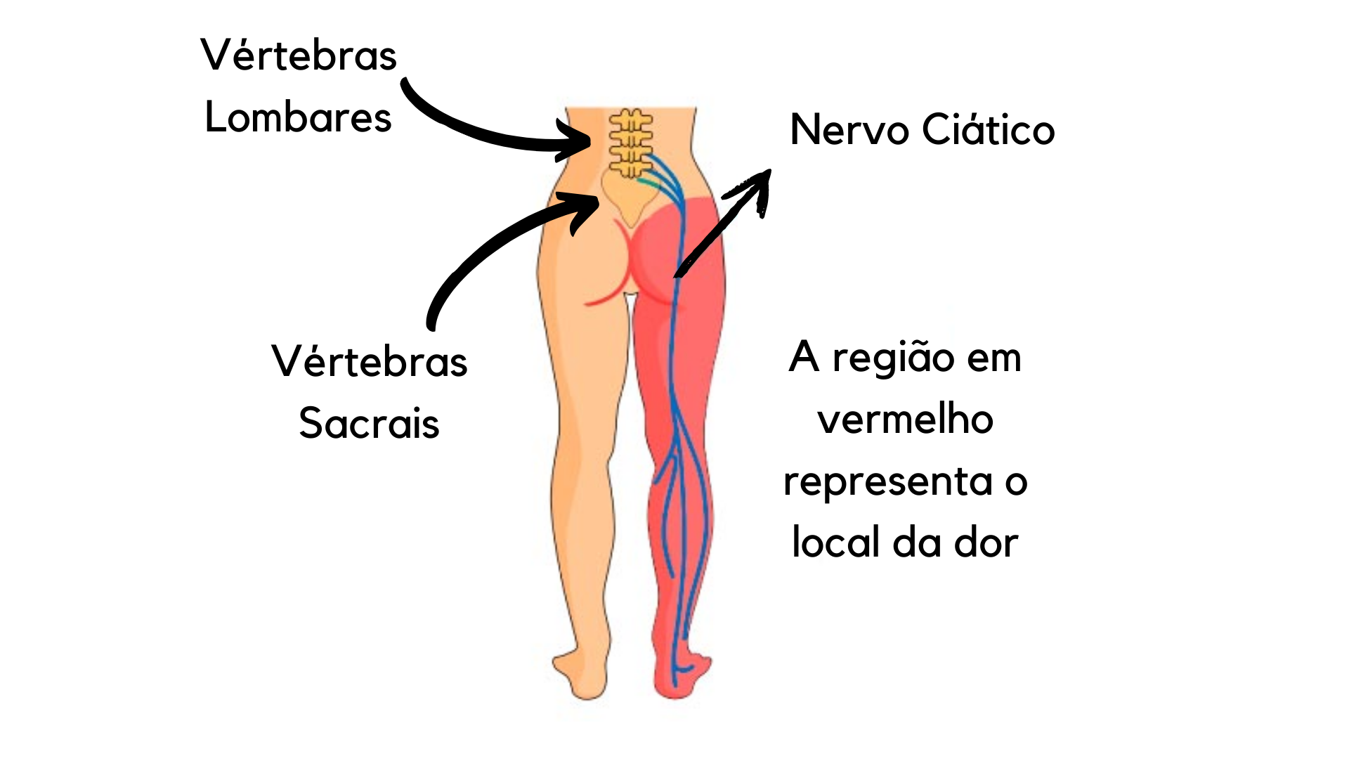 Dor No Nervo Ci Tico Quais As Causas Medicina Ortop Dica