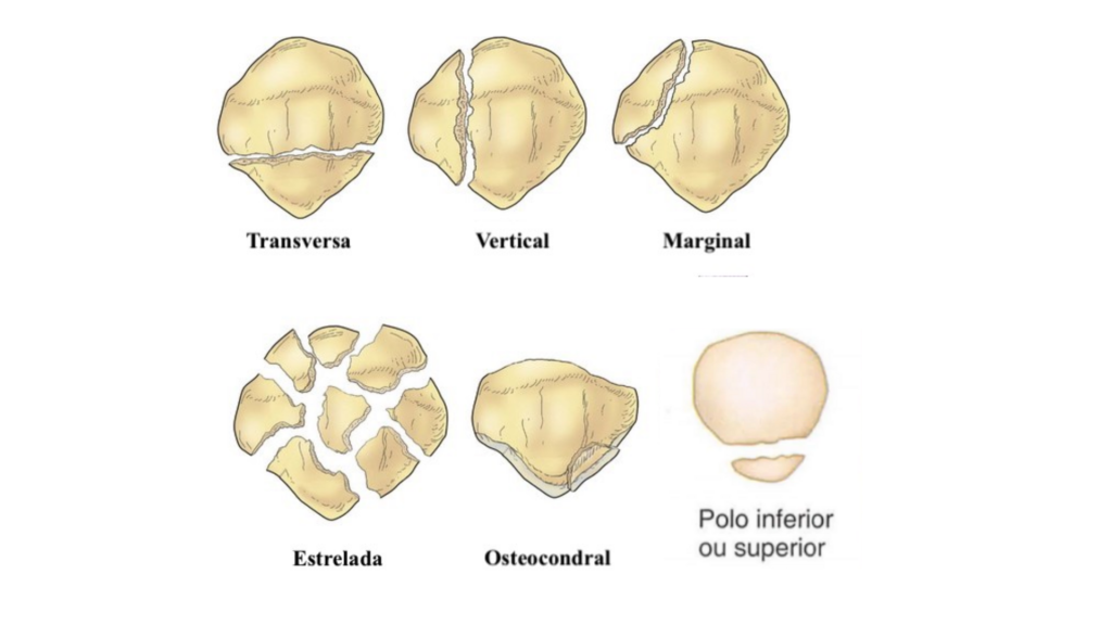 Fratura de patela