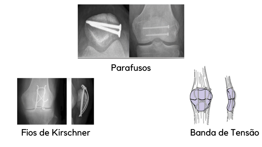 Tratamento com cirurgia fratura de patela