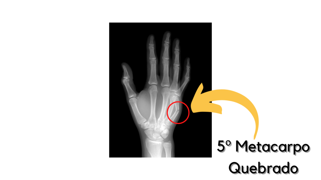 Fratura do 5º metacarpo