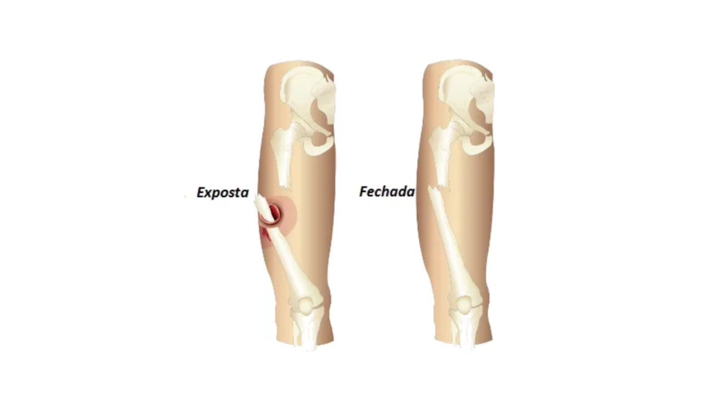Fratura exposta e fechada