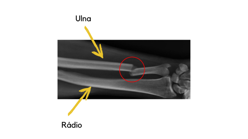 Fratura Da Ulna Saiba De Tratamentos Medicina Ortop Dica