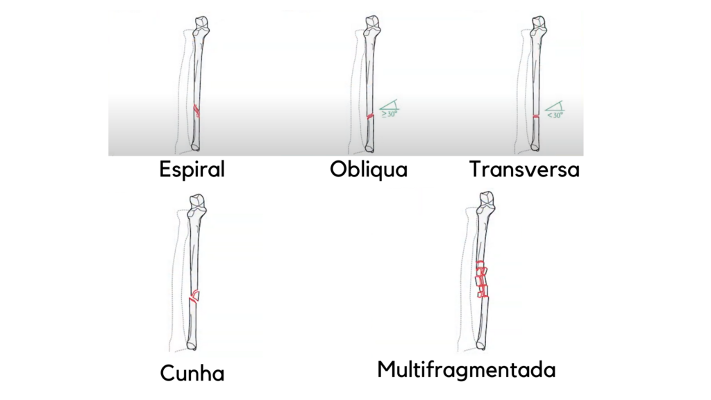 Fratura do cassetete