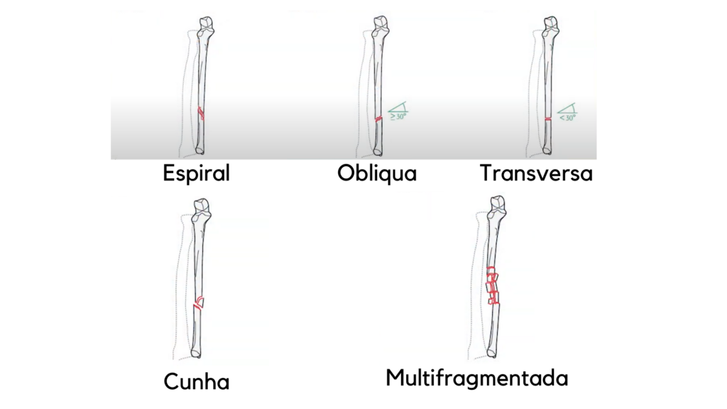 Tipos de fraturas ósseas