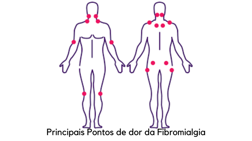 Sintomas fibromialgia