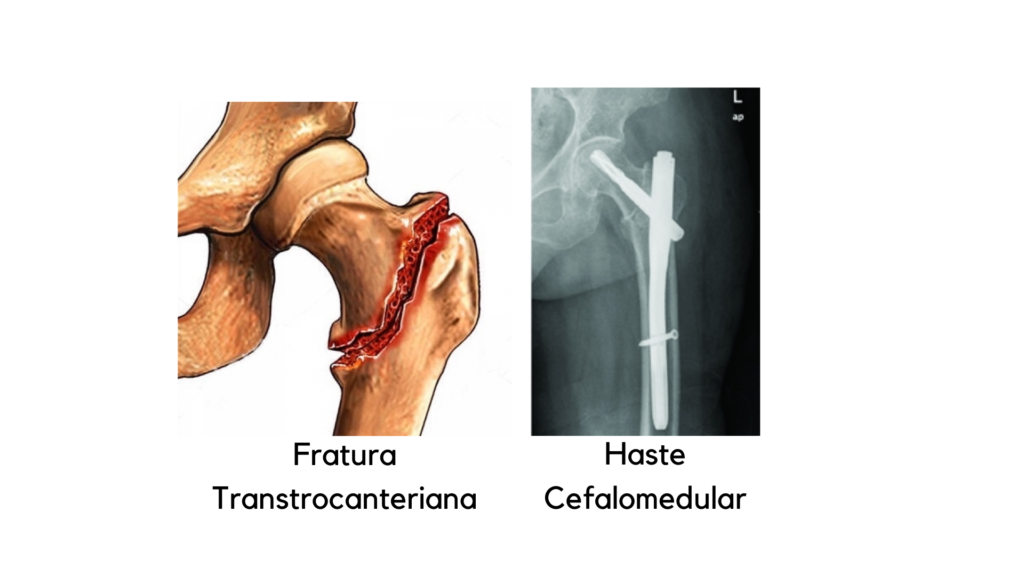 Tratamento fratura transtrocanteriana