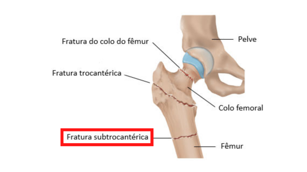 Fraturas Subtrocantéricas no fêmur