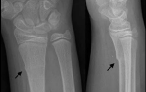 Tipos de Fraturas em Crianças