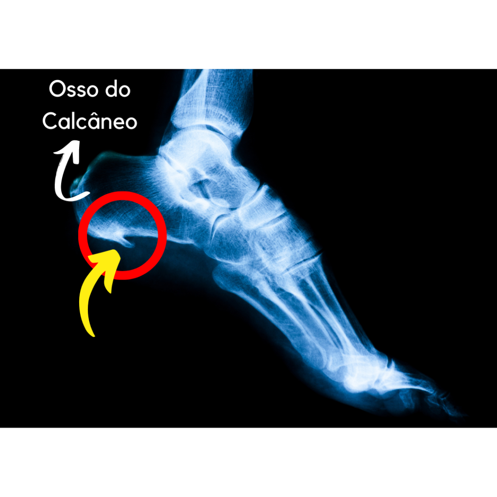 Raio x do esporão do calcâneo