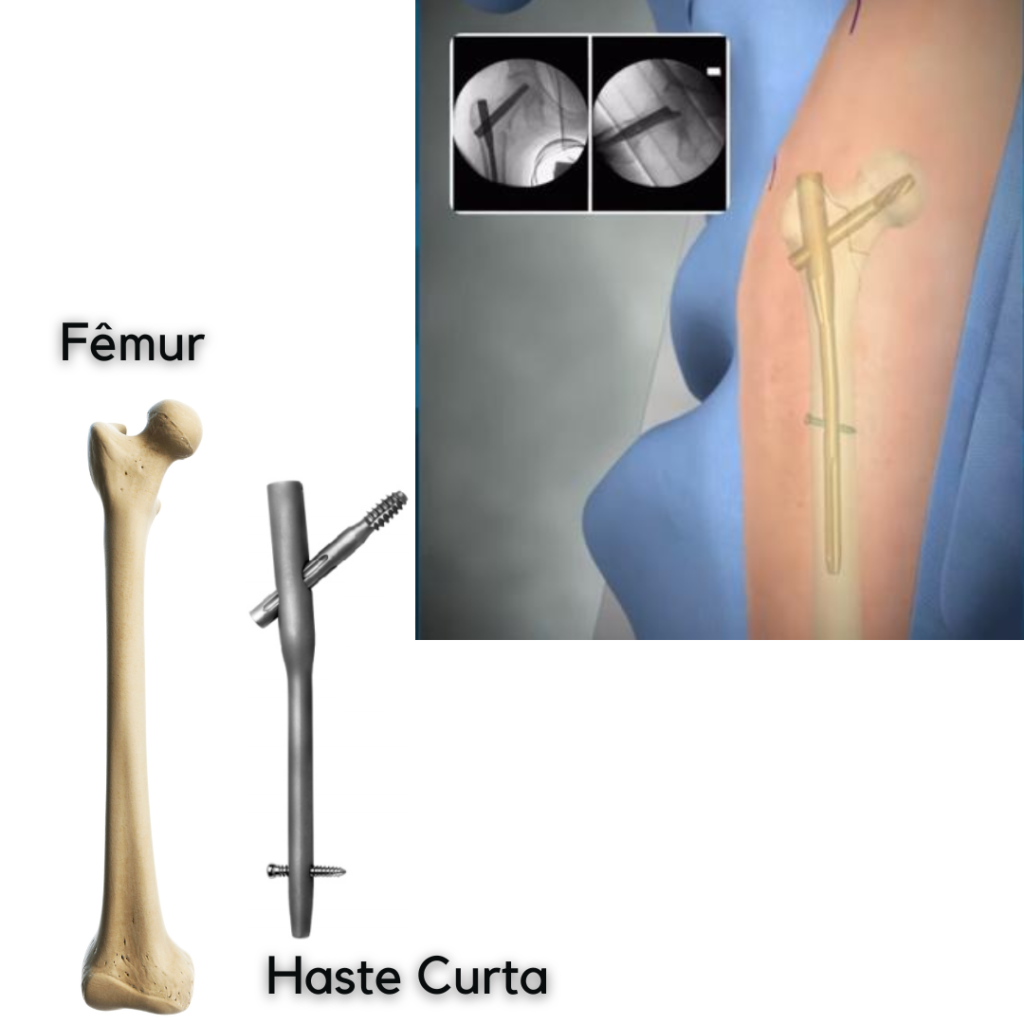 Cirurgia do fêmur com PFN - Tratamento