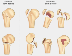úmero proximal