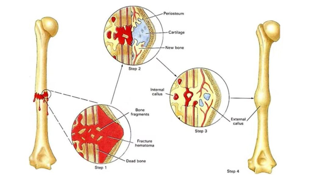 Calo ósseo formação, Calombo na fratura