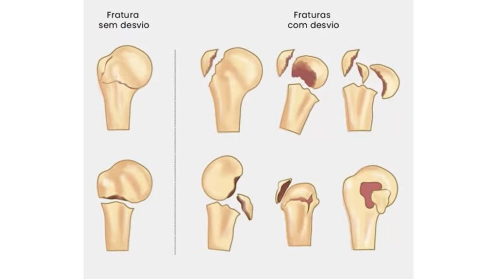 Classificação de Neer - Umero proximal