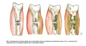 Classificacao-de-Cierny-e-Mader-Scielo