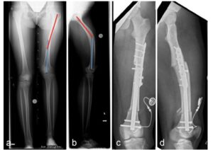 Lenze U, Krieg AH. Intramedullary lengthening nails: can we also correct deformities? Journal of Children's Orthopaedics. 2016;10(6):511–516. doi:10.1007/s11832-016-0782-0