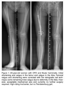 Horn J, Hvid I, Huhnstock S, Breen AB, Steen H. Limb lengthening and deformity correction with externally controlled motorized intramedullary nails: evaluation of 50 consecutive lengthenings. Acta Orthop. 2019;90(1):81-87.
