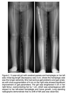 Horn J, Hvid I, Huhnstock S, Breen AB, Steen H. Limb lengthening and deformity correction with externally controlled motorized intramedullary nails: evaluation of 50 consecutive lengthenings. Acta Orthop. 2019;90(1):81-87.