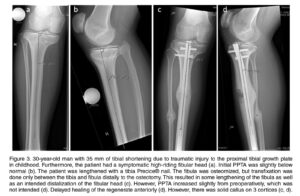 Horn J, Hvid I, Huhnstock S, Breen AB, Steen H. Limb lengthening and deformity correction with externally controlled motorized intramedullary nails: evaluation of 50 consecutive lengthenings. Acta Orthop. 2019;90(1):81-87.
