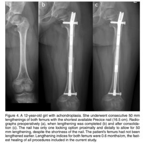 Horn J, Hvid I, Huhnstock S, Breen AB, Steen H. Limb lengthening and deformity correction with externally controlled motorized intramedullary nails: evaluation of 50 consecutive lengthenings. Acta Orthop. 2019;90(1):81-87.