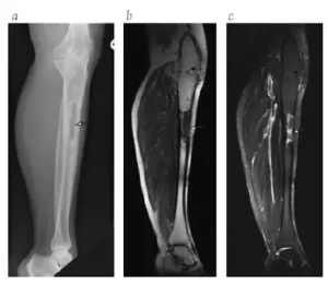 o-que-e-osteomielite-2